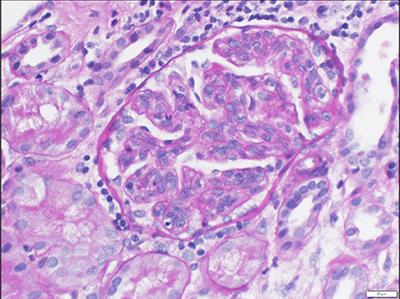 Hypocomplementemic Atypical IgA Vasculitis: A Case Report